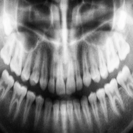 임플란트 시술 전 CT촬영 모습 