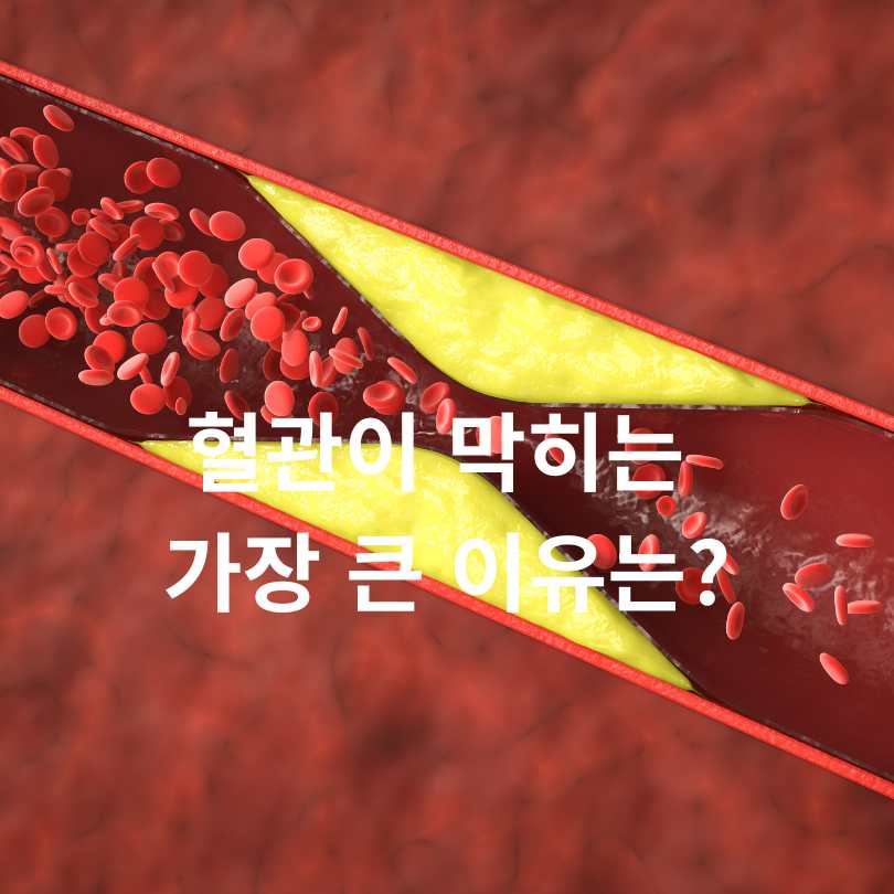 혈관이 막히는 이유? 당신이 몰랐던 진짜 원인들!