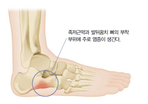 족저근막염 슬리퍼