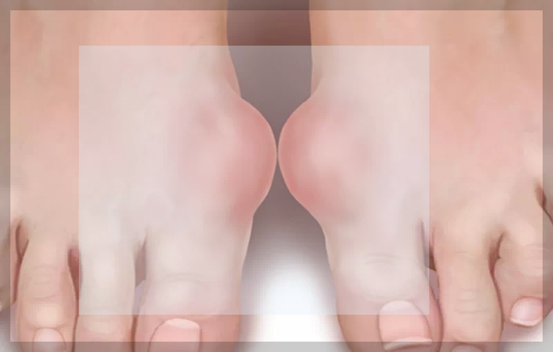 통풍 관절염