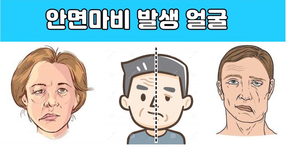 삼차신경,안면마비 자가진단 차이