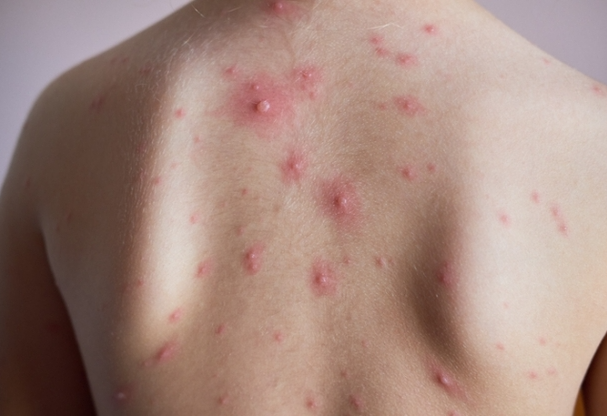 홍역 증상 완벽 가이드