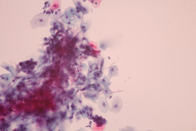 염증수치가 높은 이유