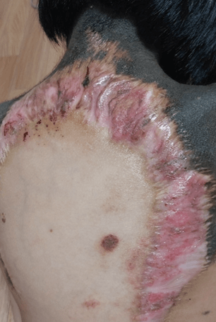 살이 불에 타는것 같아요1