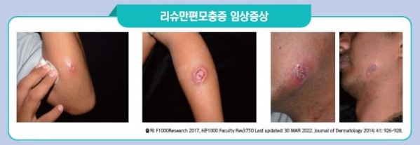 리슈만편모충 감염의 증상