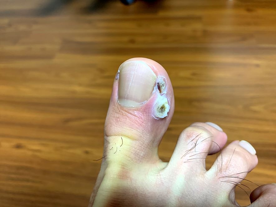 엄지발가락 엔드와츠 치료과정