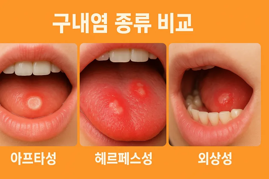 구내염 치료법