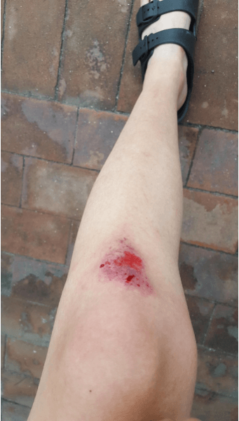 달리다가-무릎이-깨저-피가나고-멍이든-모습