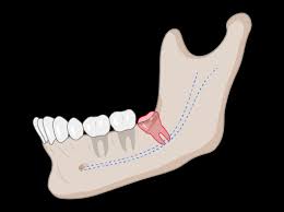 사랑니 발치 후 식사 가이드
