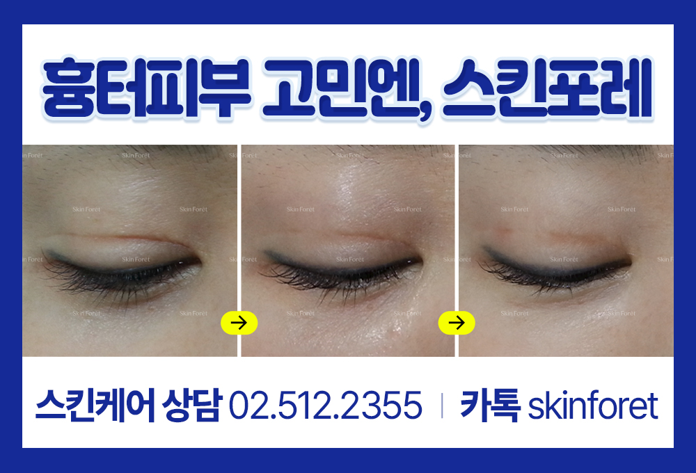 눈매교정과 쌍꺼풀 흉살로 인한 라인 관리 과정
