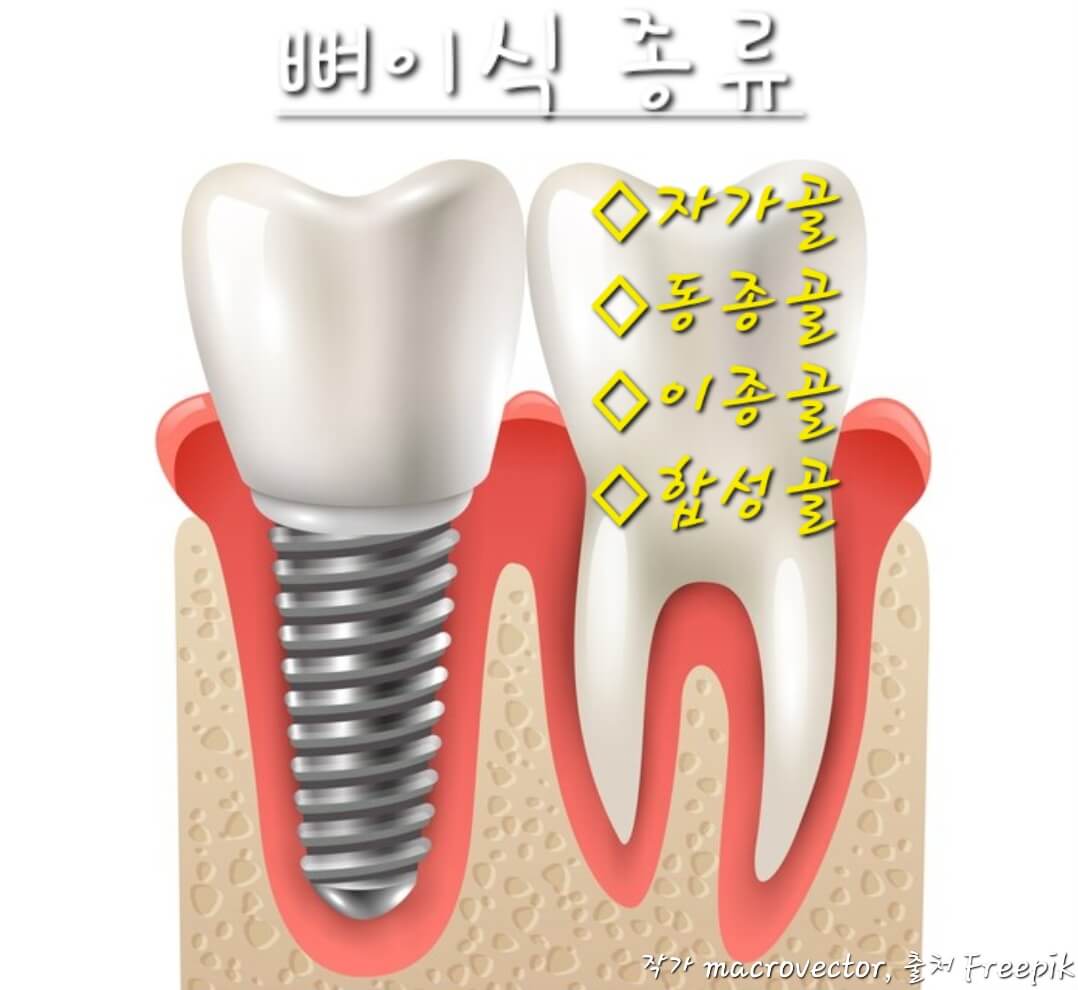 뼈이식 종류 사진