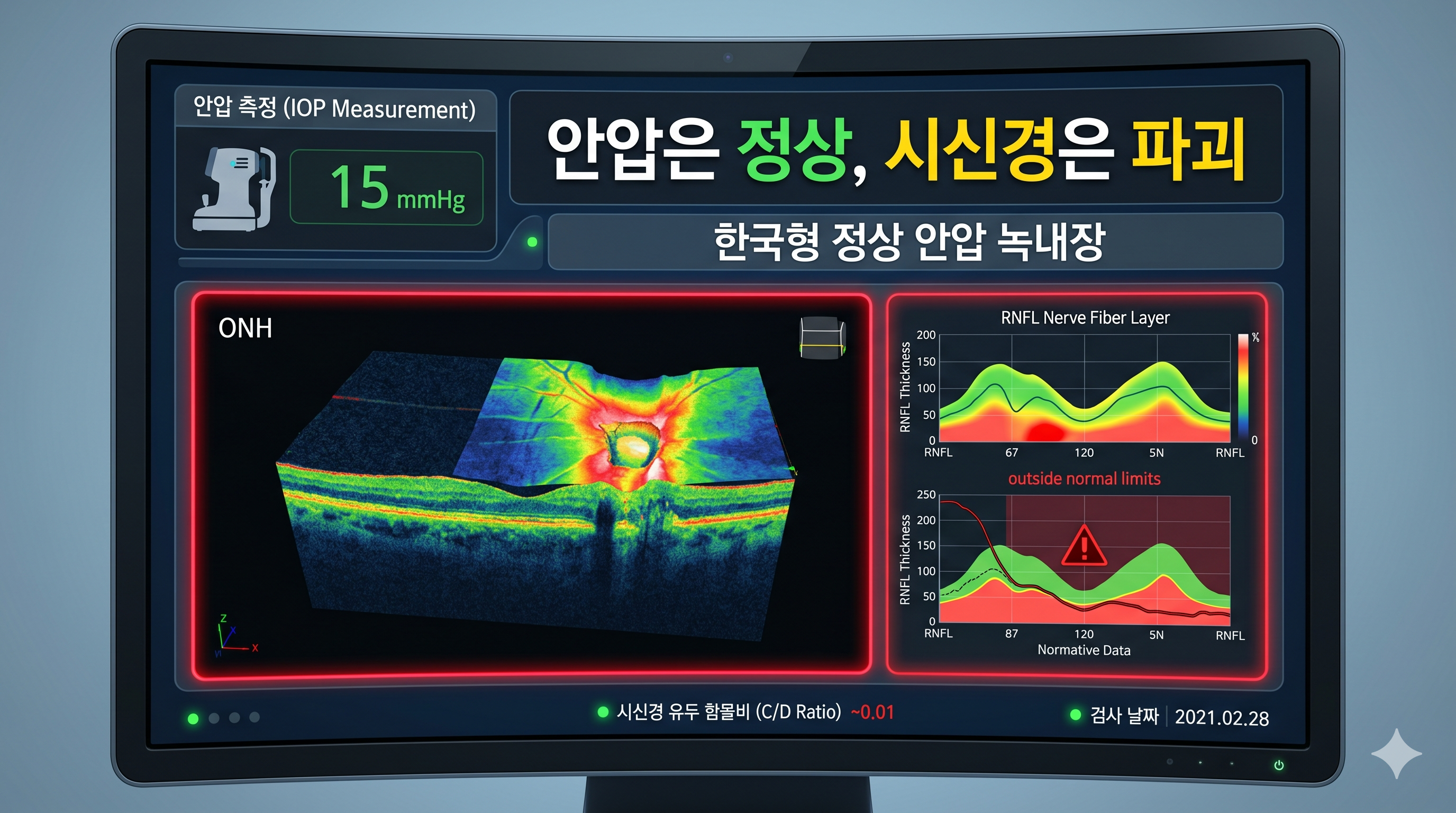 정상안압 녹내장, 안과 OCT 검사, 안압 정상수치 - 안압은 정상(15mmHg)으로 표시되지만, 정밀 시신경 단층촬영(OCT) 화면에서는 신경이 얇아진 위험 구간이 붉게 표시되는 3D 진단 시뮬레이션