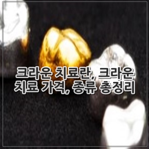 크라운 치료란, 크라운 치료 가격, 종류 총정리