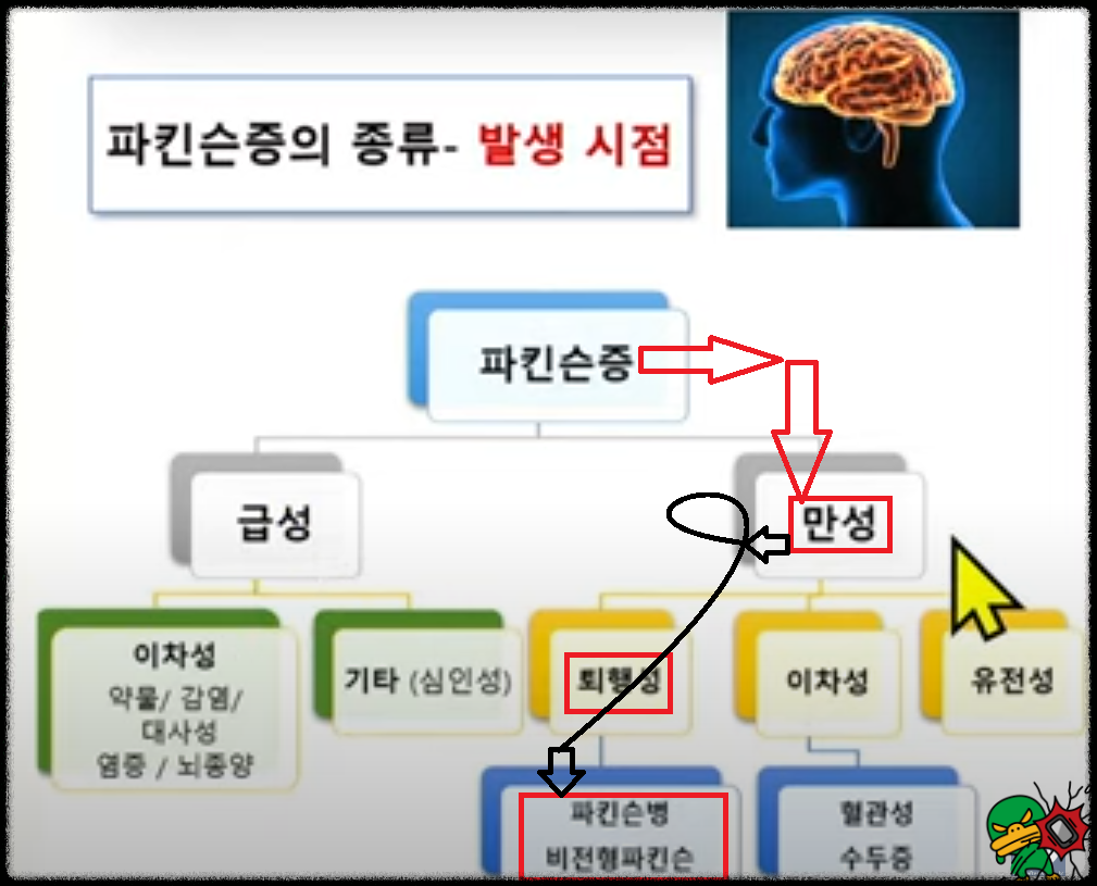 발생시점으로 분류하는 파킨슨증 환자