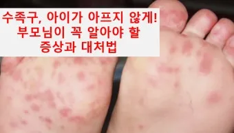 수족구 초기 증상 어른 감염 격리기간 예방 치료 완전 가이드_14