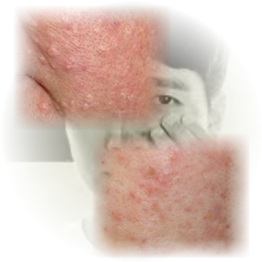 피지선증식증: 40대 이후 급증! 조기발견과 치료가 중요한 이유