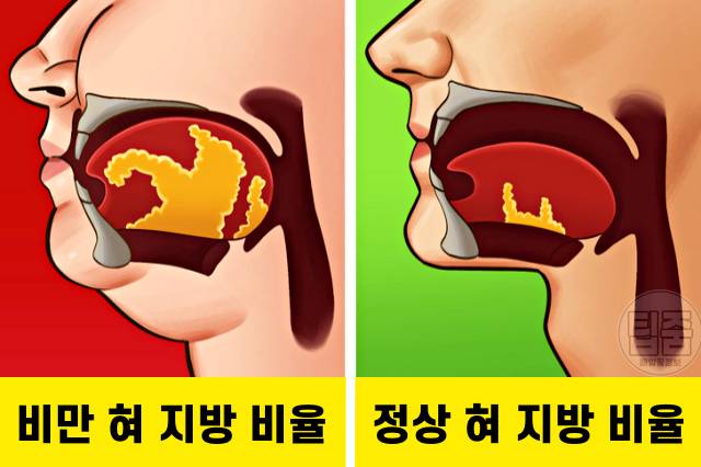 코골이 고치는법 다이어트 코골이방지 수술 치료