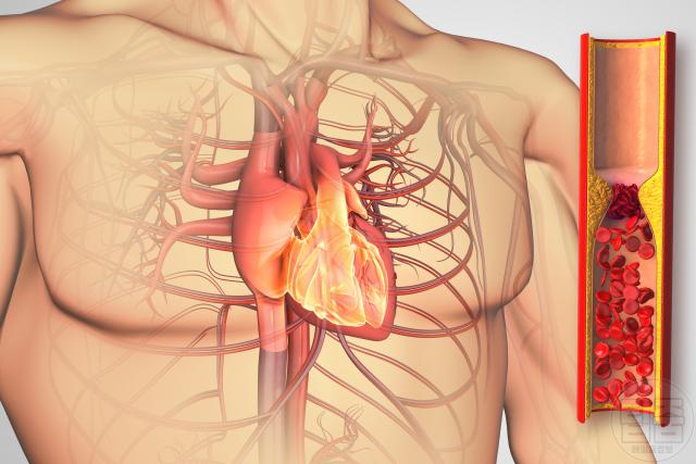 러닝 가슴통증 원인 협심증
