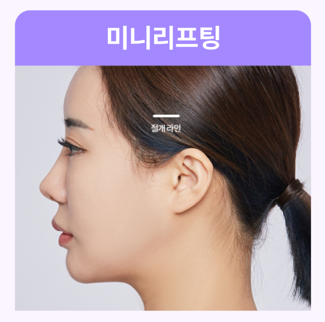 스마일리프팅후기 강남리프팅피부과