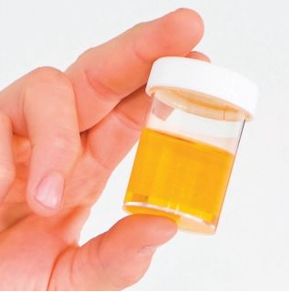 소변색깔이 노란색 원인