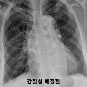 제한성 환기장애