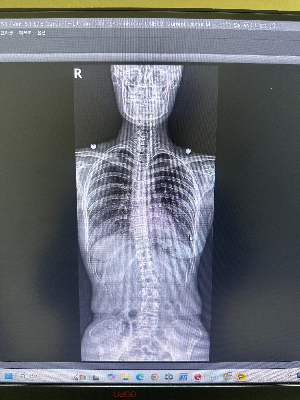방사선사 모니터에서 확인하는 척추측만증(Scoliosis) 환자의 전척추 X-ray 영상