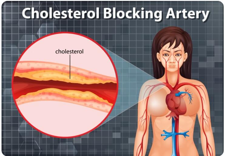 여성 혈관 속 혈액 찌꺼기 양을 보여주는 모습