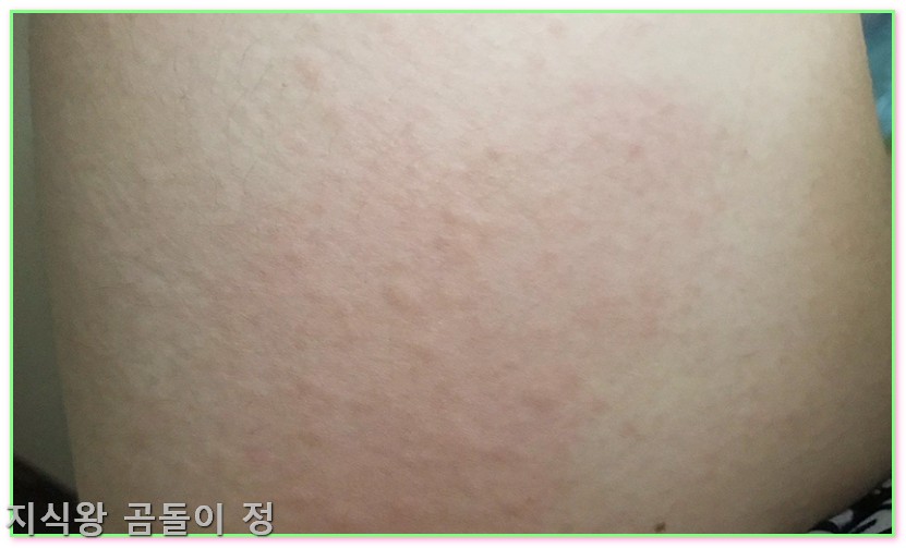 온몸 간지러움 전신 가려움증 두드러기 피부장벽 관리와 보습 루틴 꿀팁1