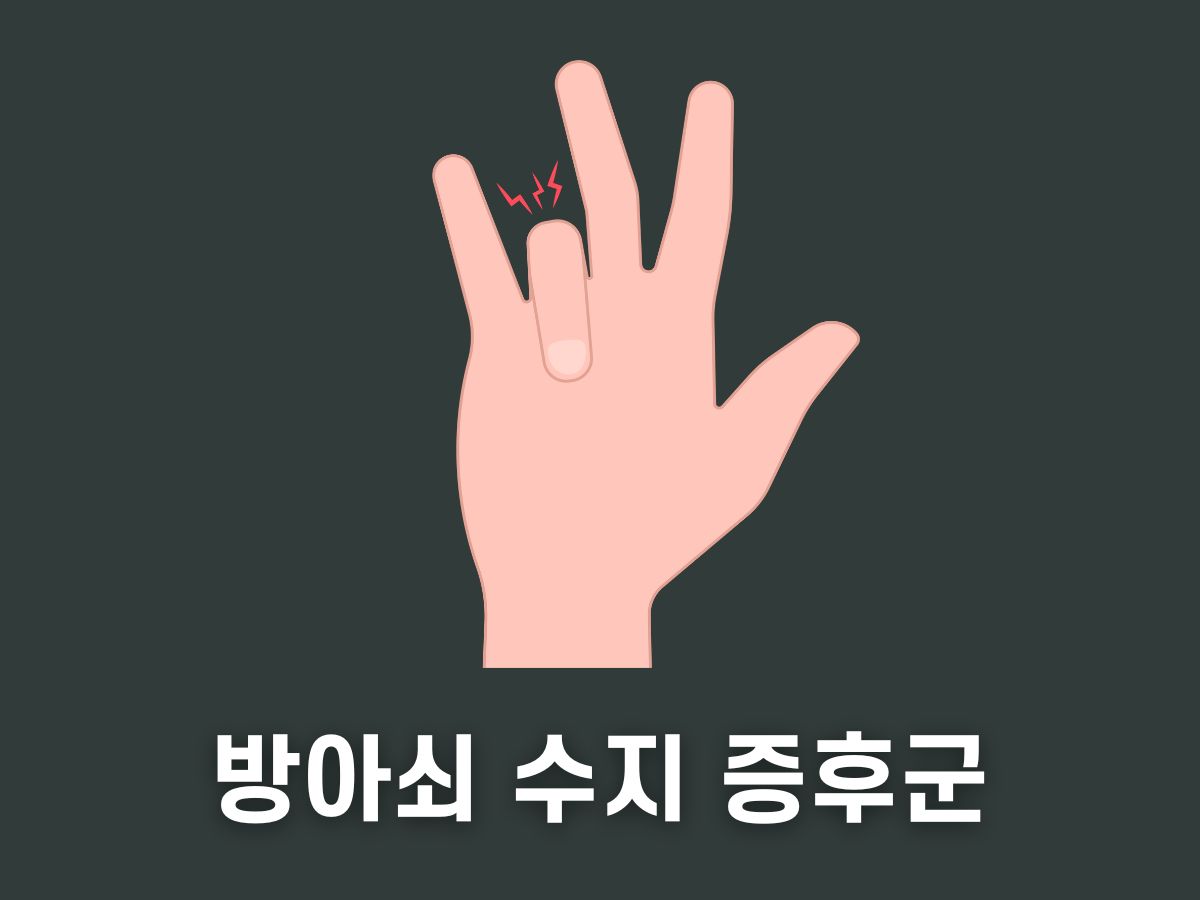 방아쇠 수지 증후군