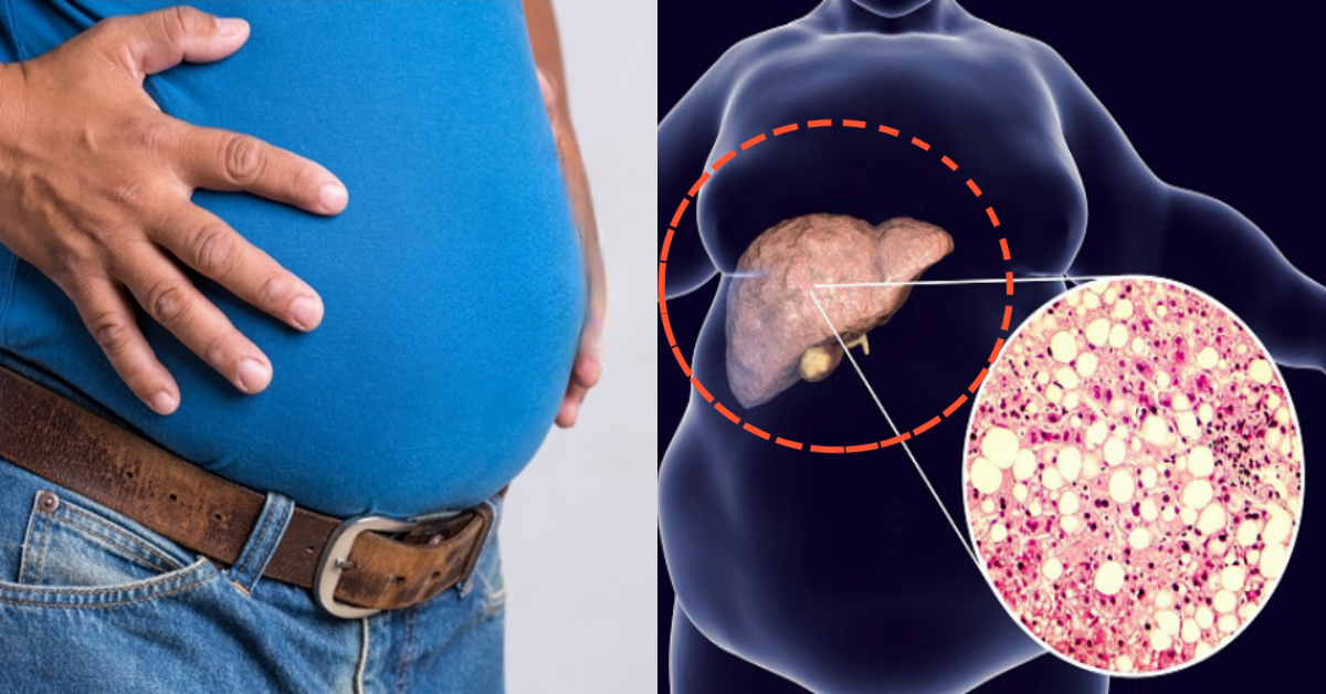 간 건강 위해 '이 음식' 조절하면 살이 빠지는 진짜 이유?