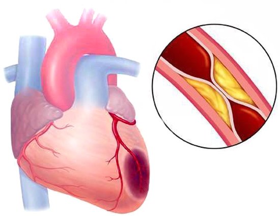 심근경색 전조증상