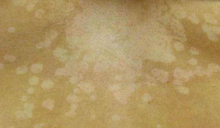 어루러기