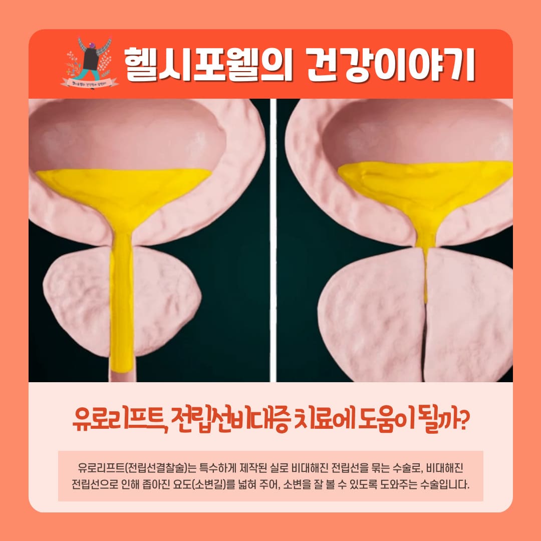 유로리프트, 전립선비대증 치료에 도움이 될까?