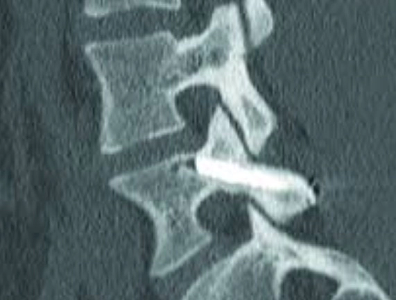 척추분리증에 좋은 운동 및 자가진단