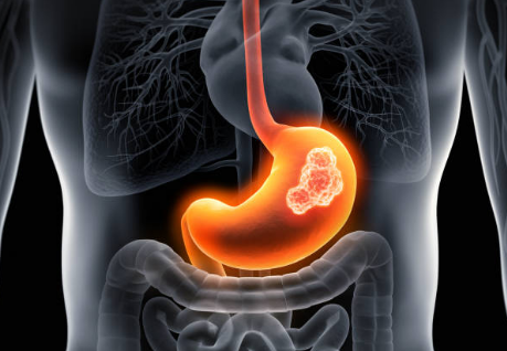 위암 초기증상, 수술비용, 수술후 회복기간 총정리 (2024ver)