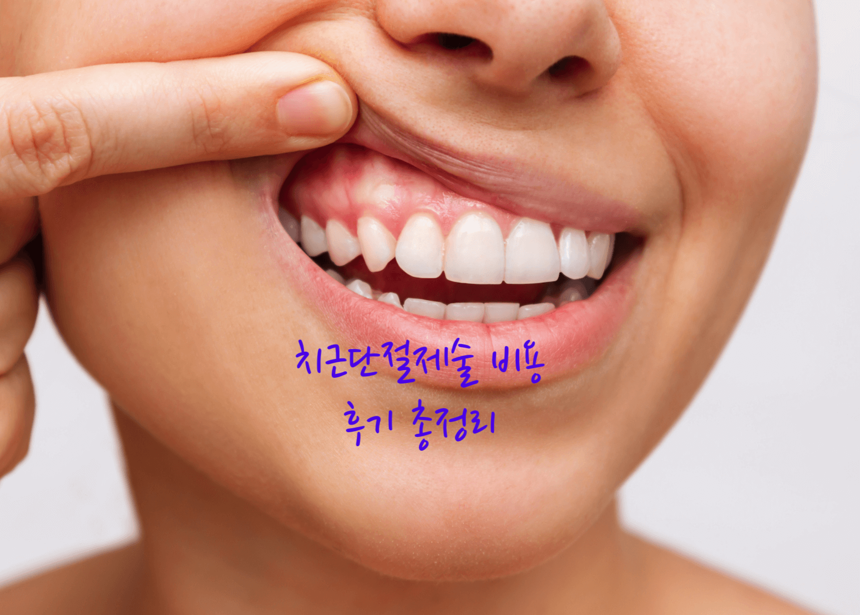 치근단절제술