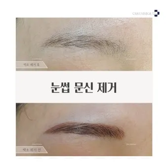 눈썹 문신 제거 방법 꿀팁_10