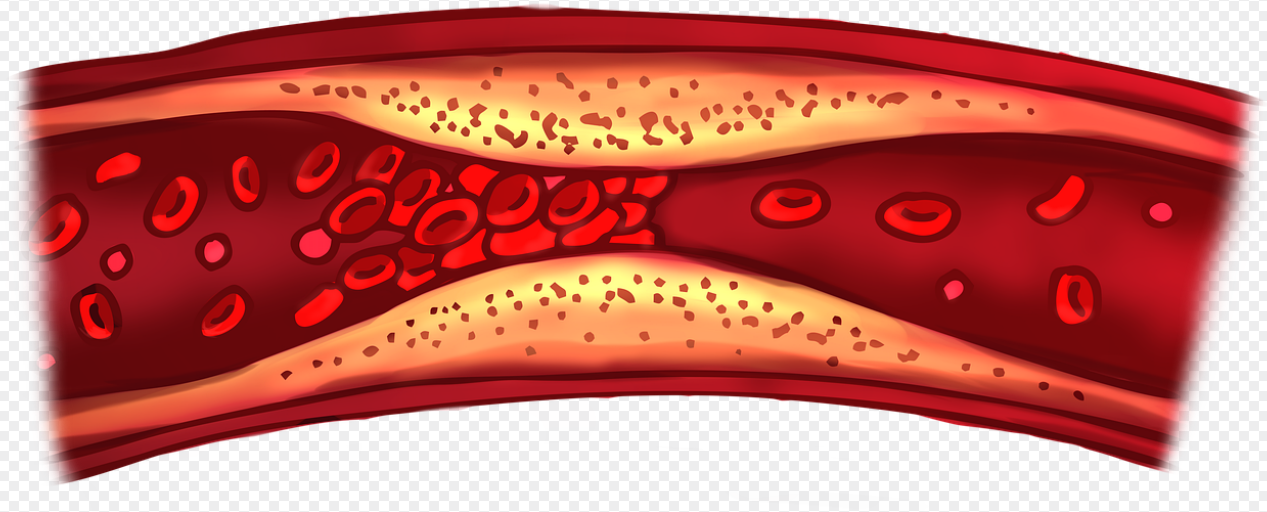 혈전증 관련 사진