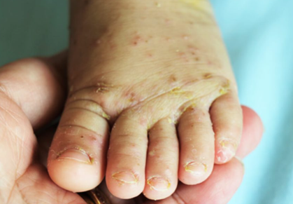 수족구병 환아의 발 이미지