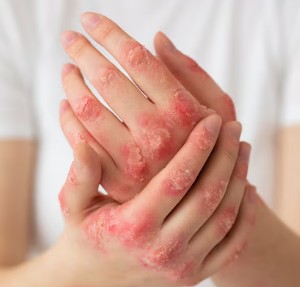 콜린성-두드러기-6