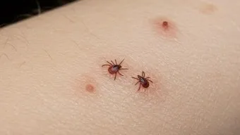 진드기 물린자국 대처법 참진드기 빨간 진드기 증상 확인_33