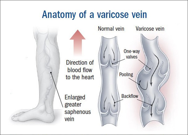 하지정맥류 증상설명 포스터