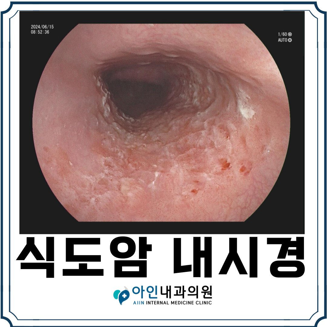 식도암