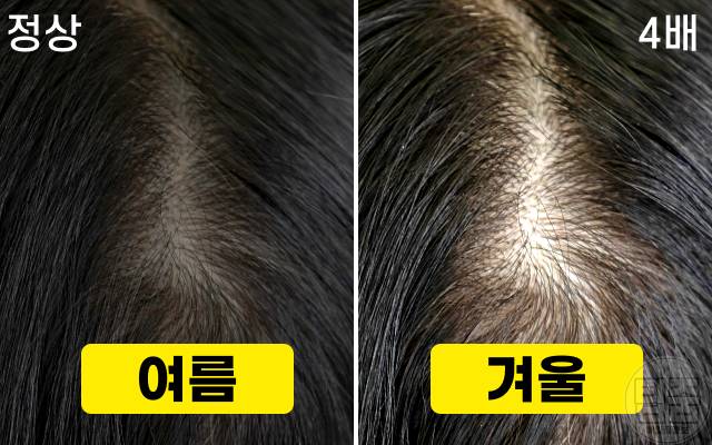 겨울철 탈모,두피 보호,모발