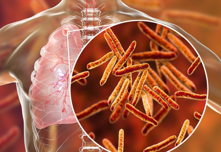 잠복결핵 양성 증상