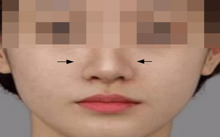 코성형 후 여성의 코 모습
