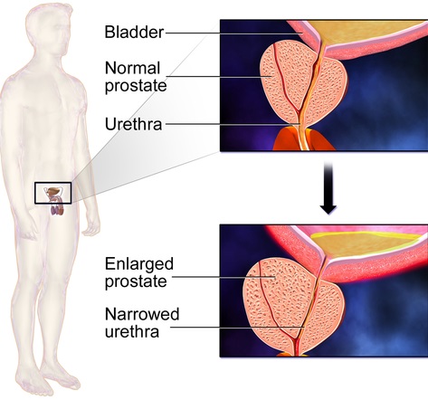 전립선 비대증 이해를 돕기 위한 이미지