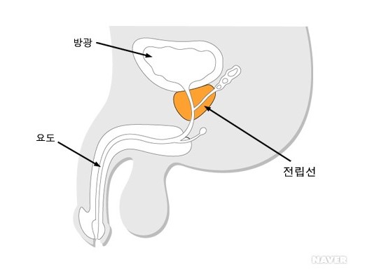 전립선비대증 사진