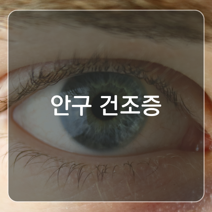 안구건조증