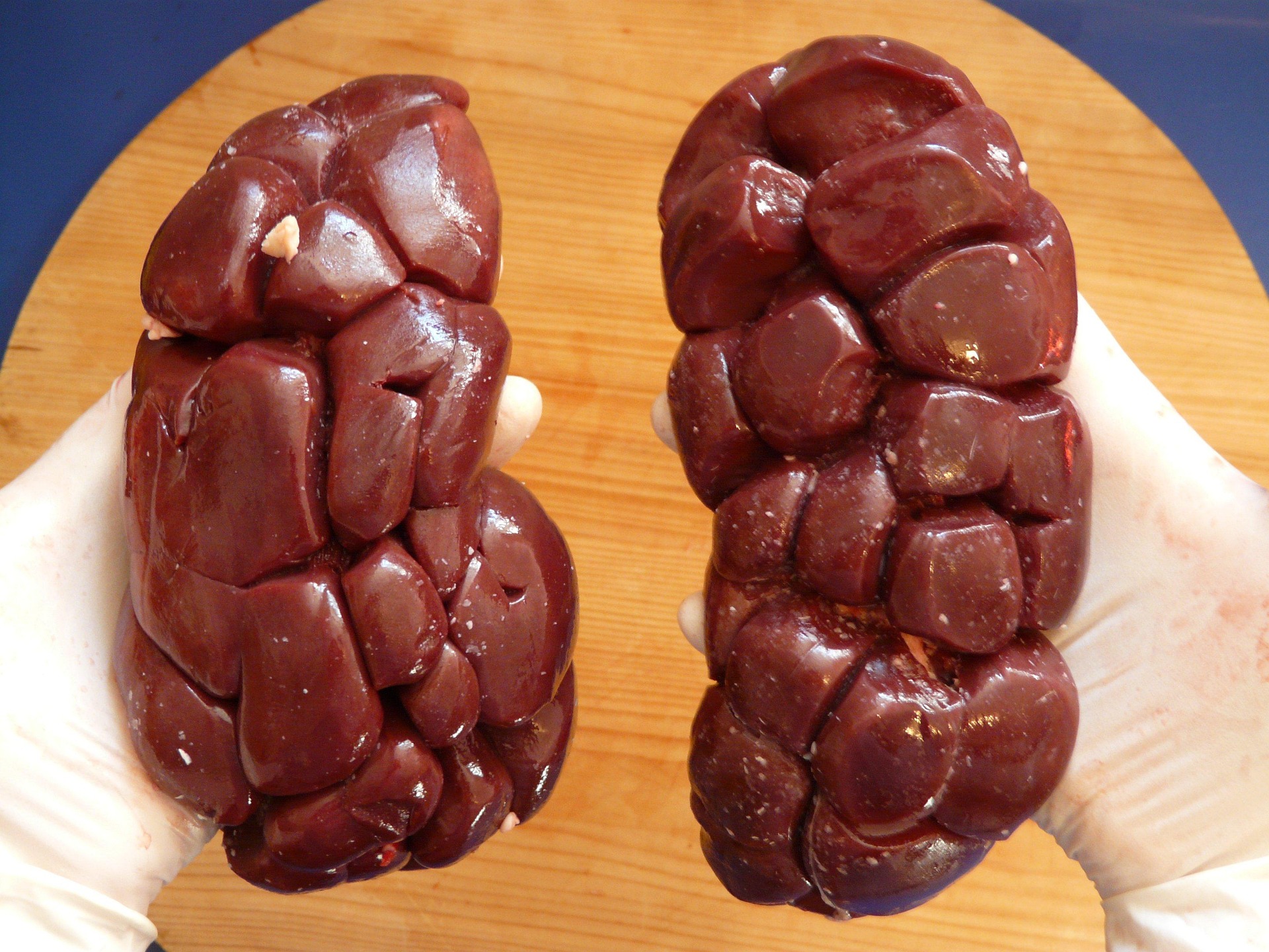 신장 기능 수치(Creatinine, eGFR) 쉽게 이해하기
